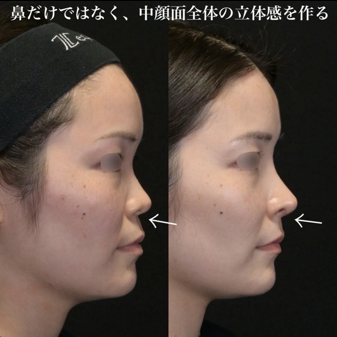 鉄医師による鼻整形の術前/術後３ヶ月 施術後 
