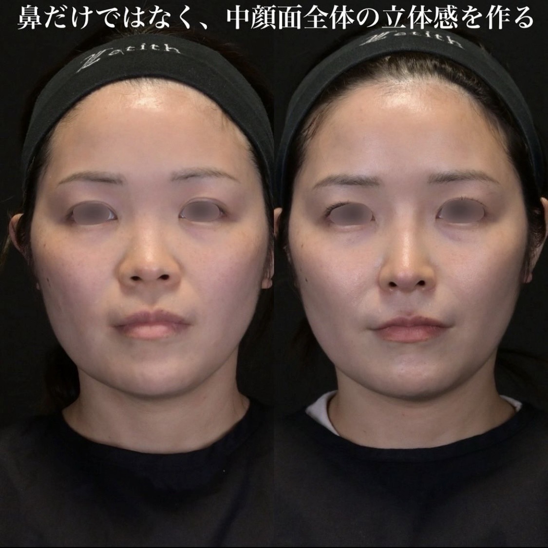 鉄医師による鼻整形の術前/術後３ヶ月