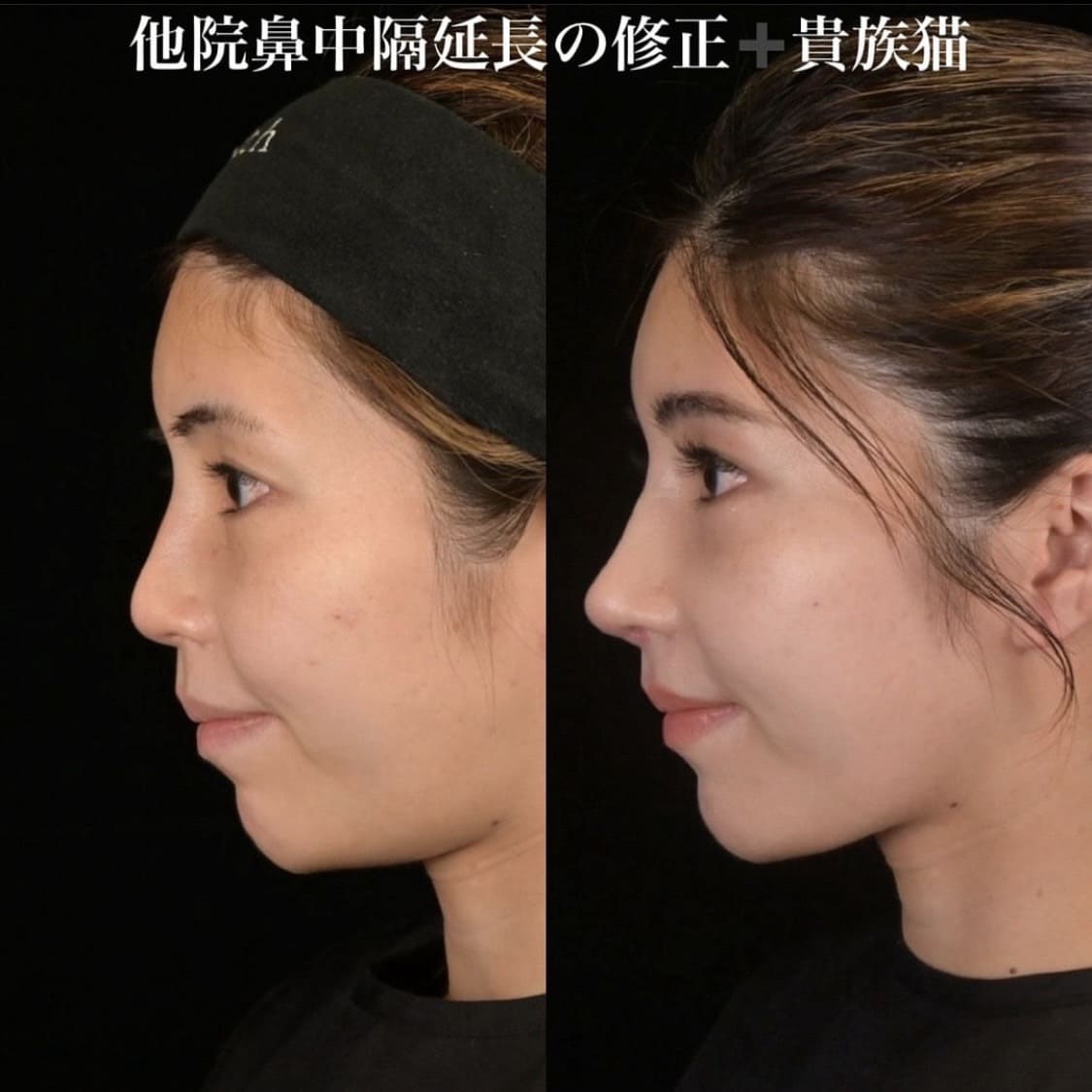 鉄医師による鼻整形の術前/術後1ヶ月