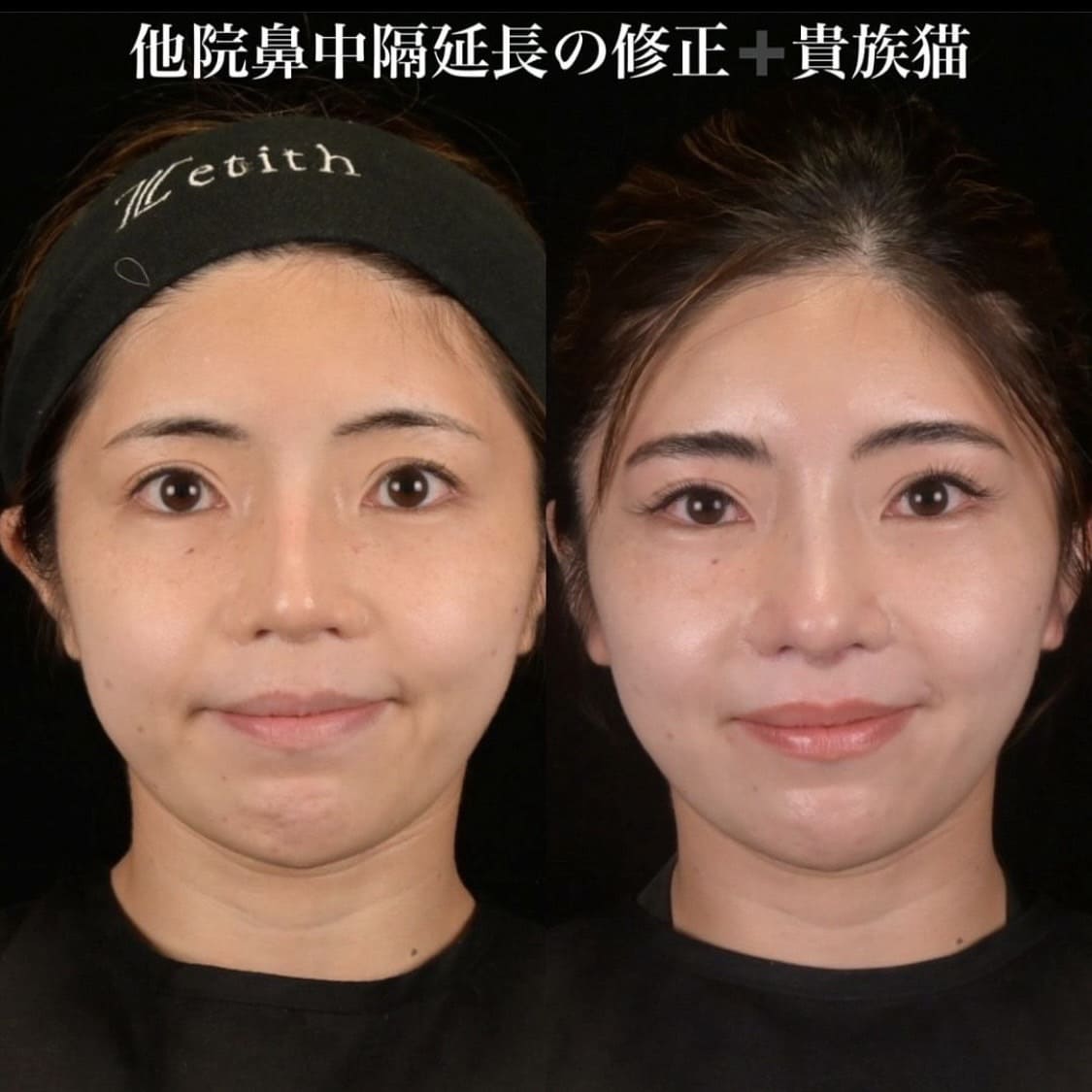 鉄医師による鼻整形の術前/術後1ヶ月 施術後 