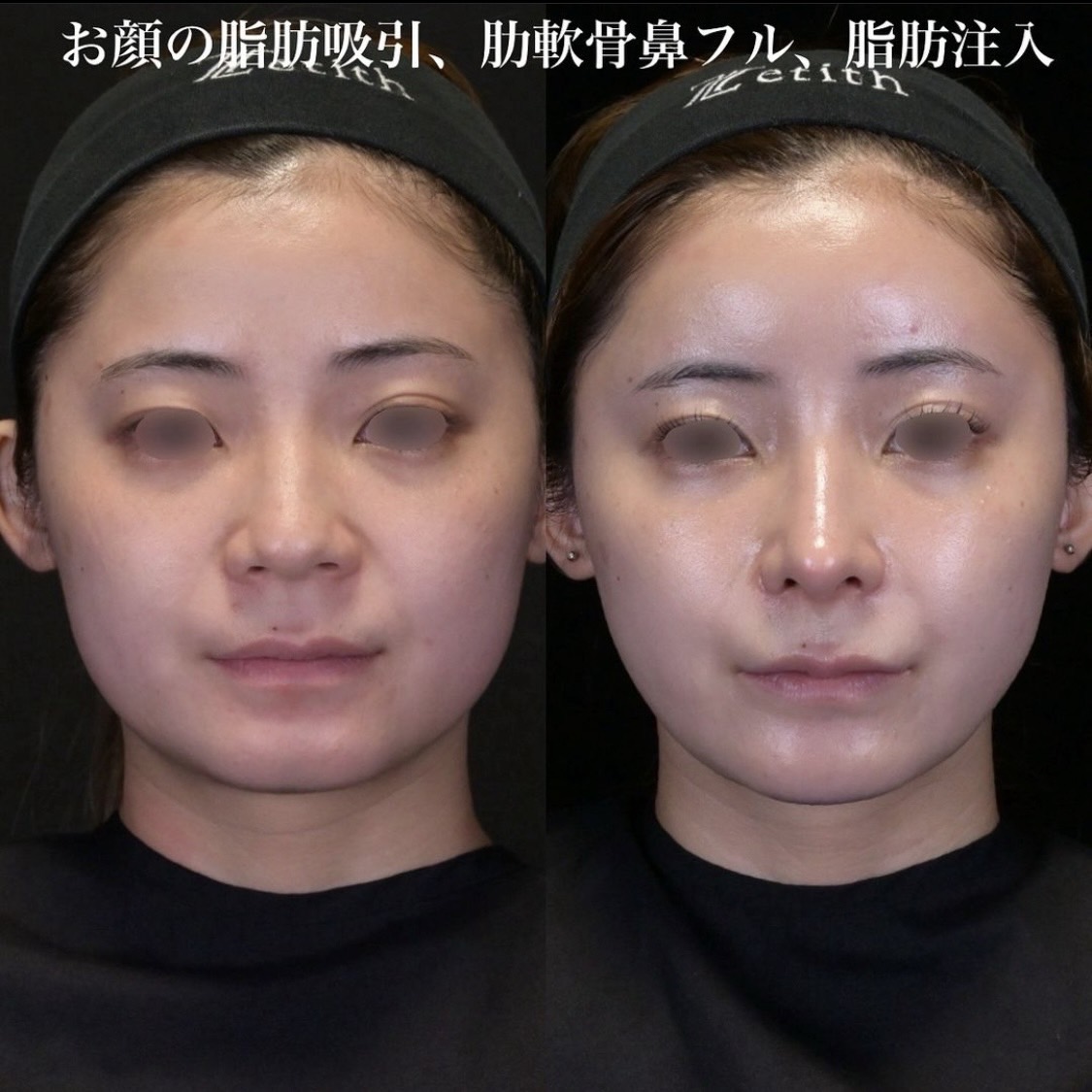 症例写真