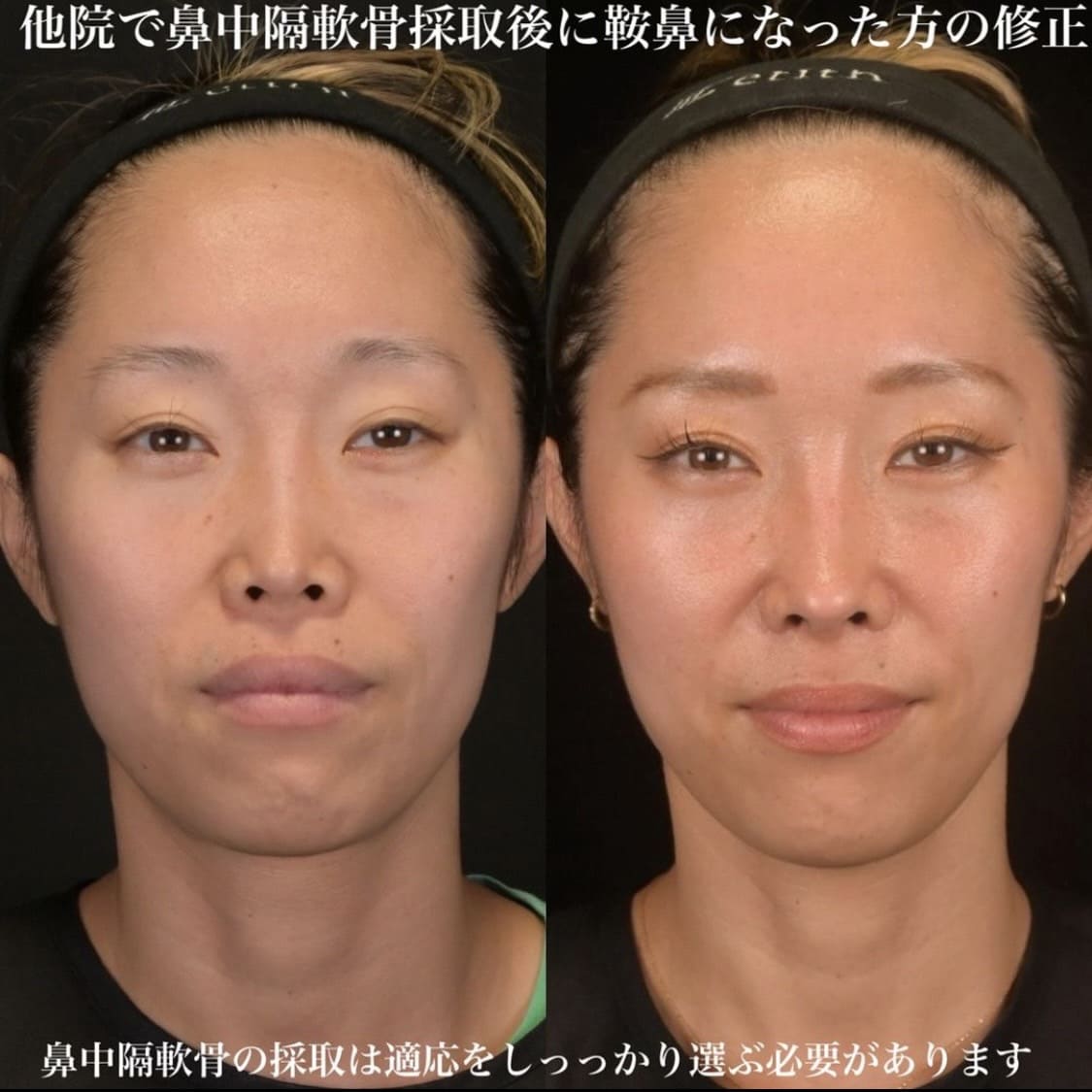 症例写真