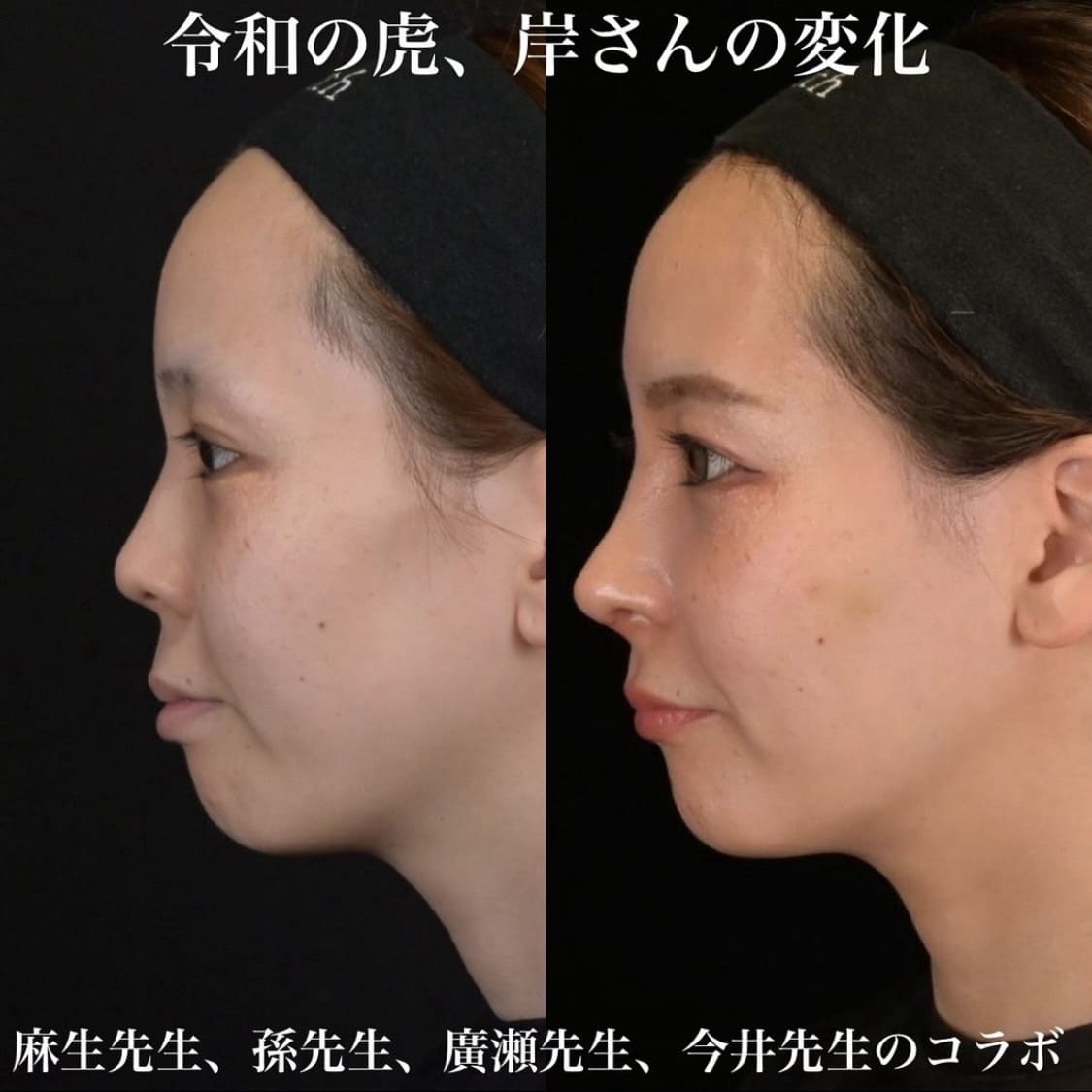 鉄医師による鼻整形の術前/術後３ヶ月 施術後 