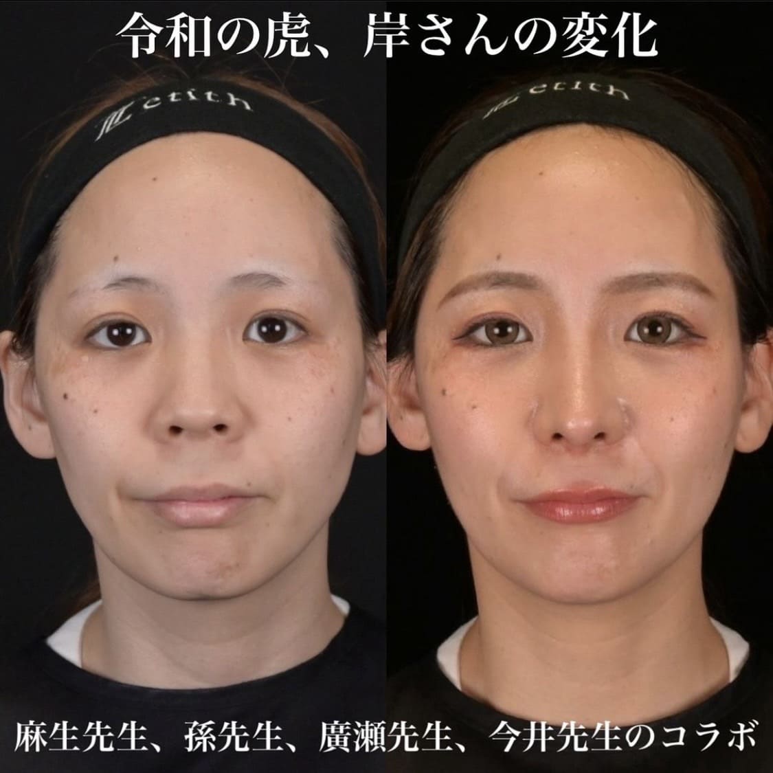 鉄医師による鼻整形の術前/術後３ヶ月
