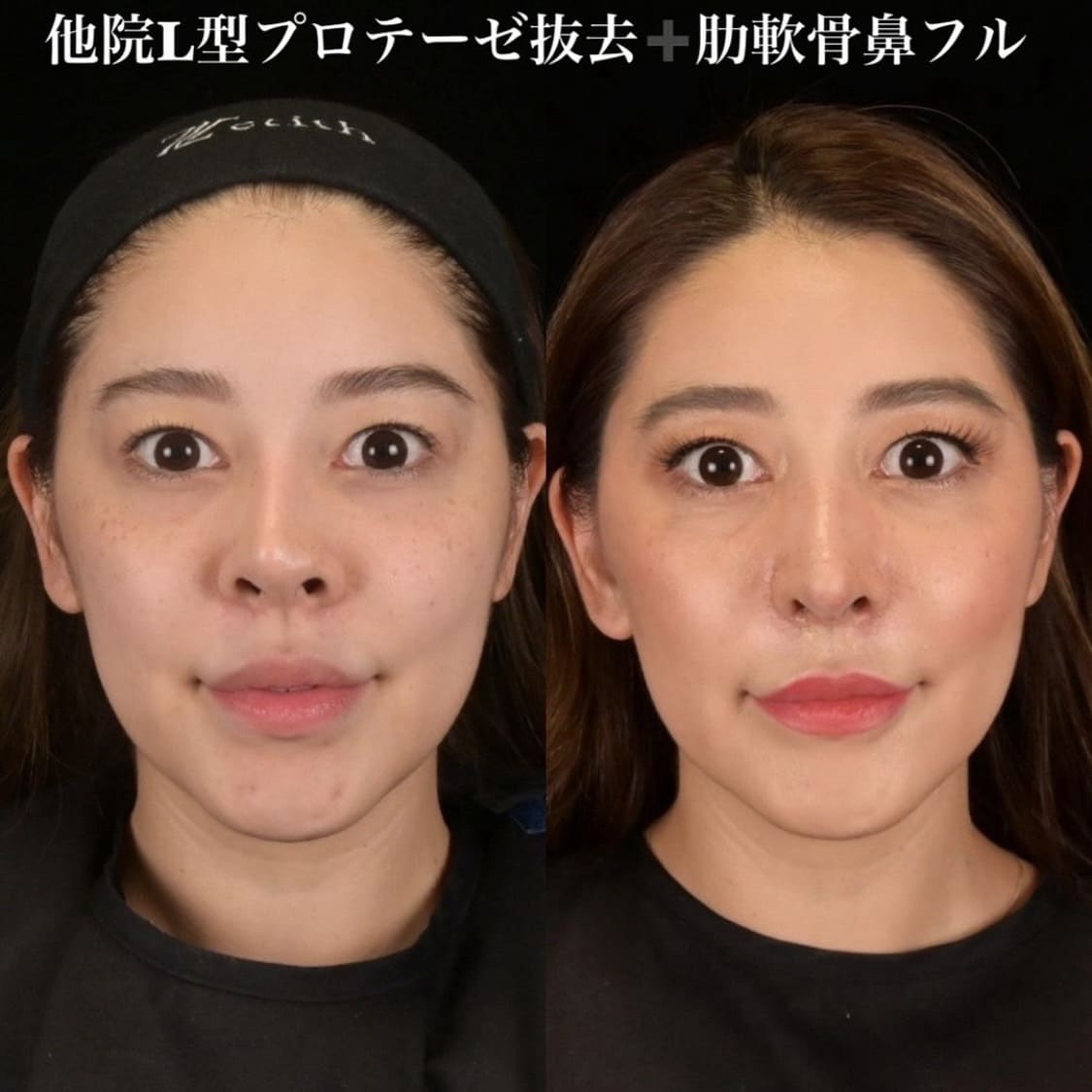 鉄医師による鼻整形の術前/術後2週間