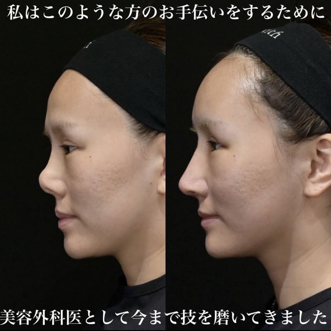 鉄医師による鼻整形の術前/術後1ヶ月 施術後 