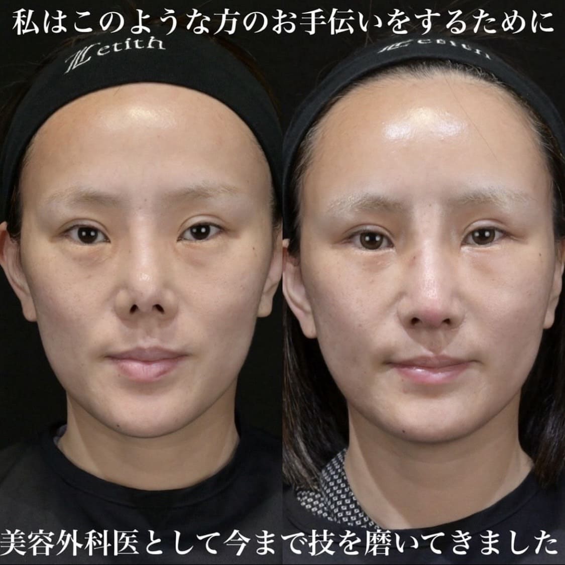鉄医師による鼻整形の術前/術後1ヶ月