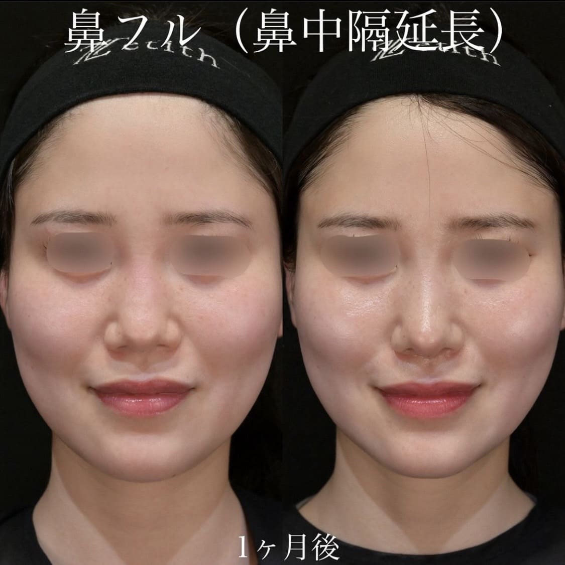 上木原医師による鼻整形の術前/術後1ヶ月 施術後 