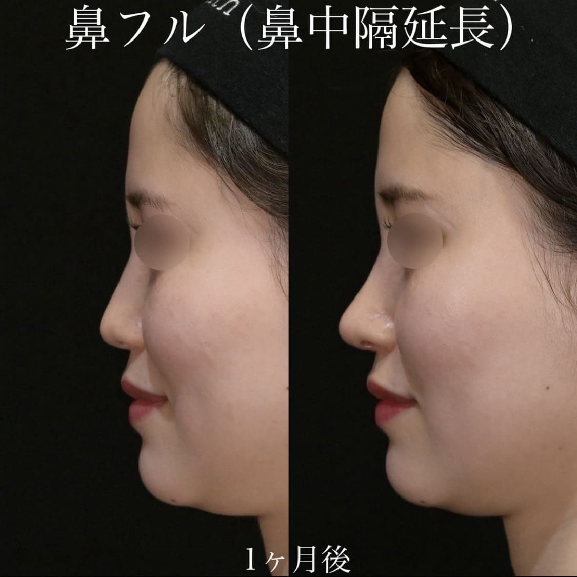 上木原医師による鼻整形の術前/術後1ヶ月
