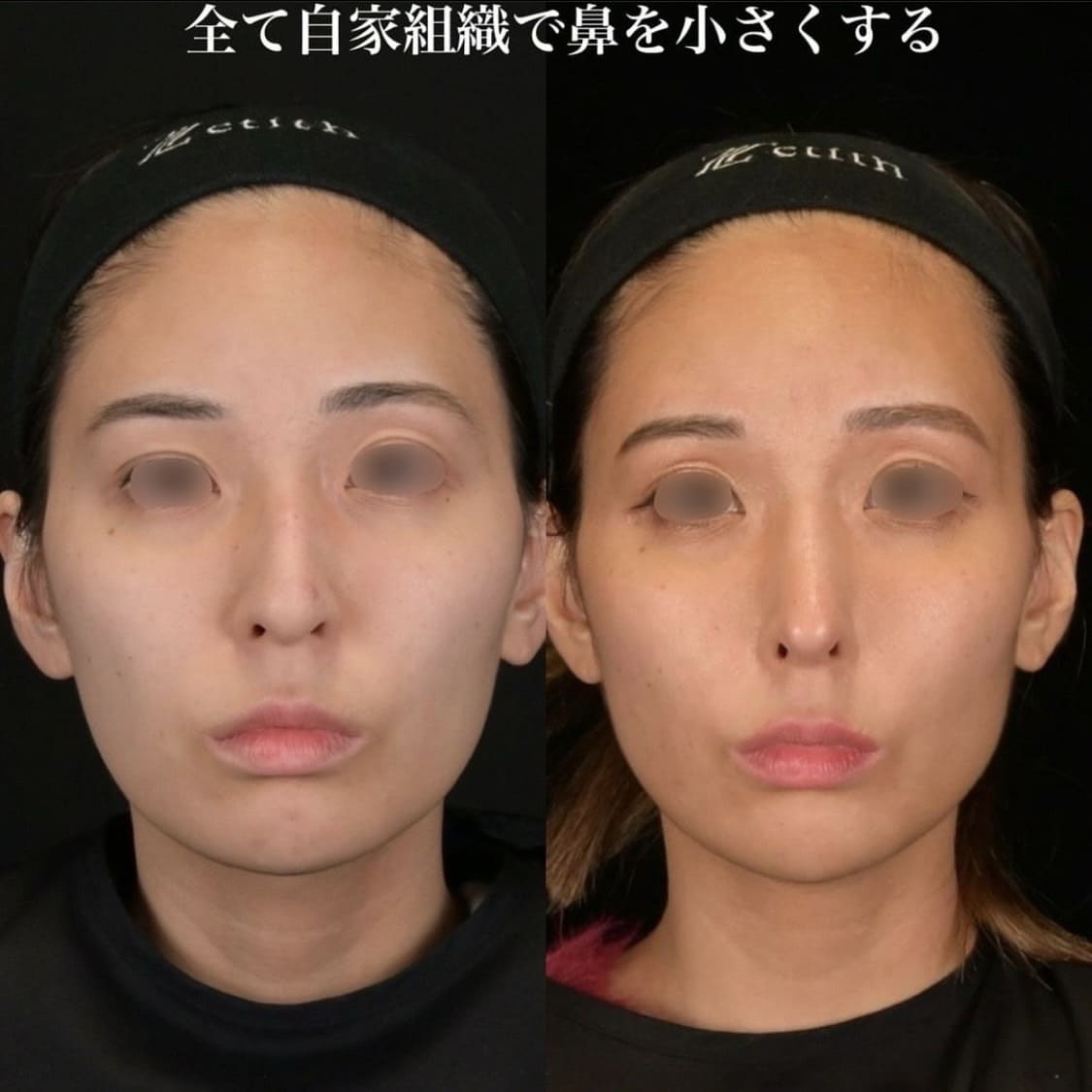 鉄医師による鼻整形の術前/術後6ヶ月 Sonra 