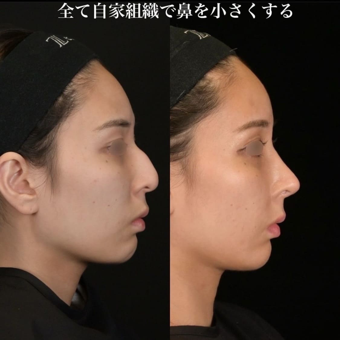 鉄医師による鼻整形の術前/術後6ヶ月