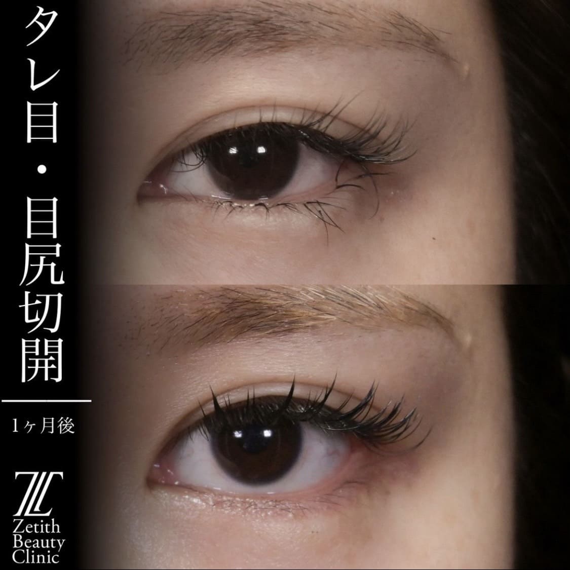 上木原医師による目元整形の術前/術後1ヶ月 หลัง 