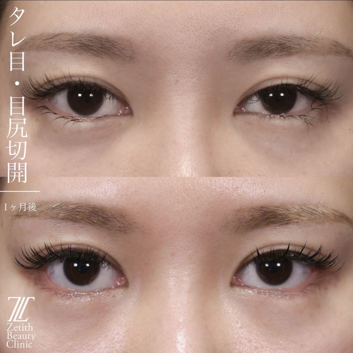 上木原医師による目元整形の術前/術後1ヶ月
