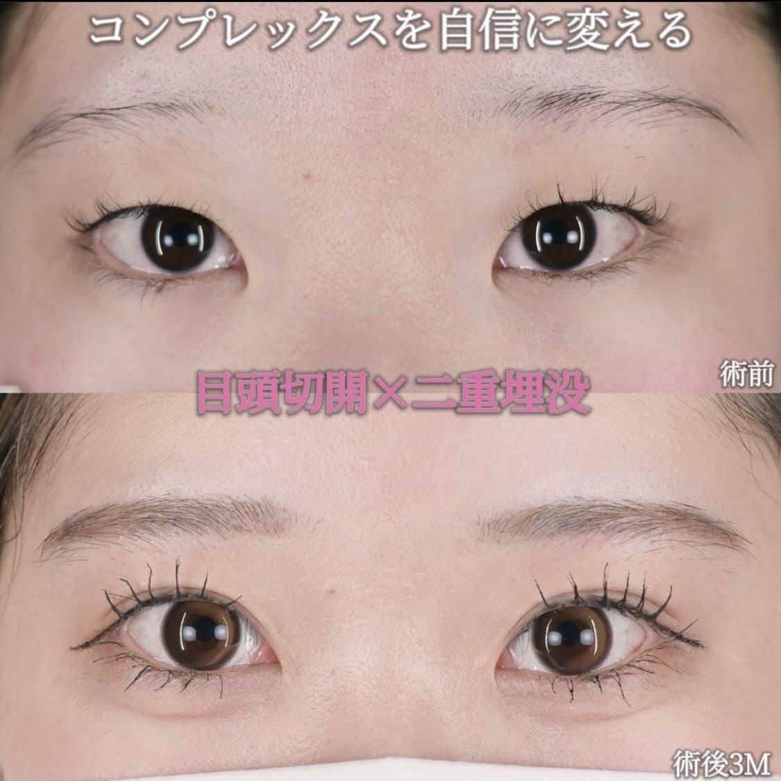 沈医師による目元整形の術前/術後３ヶ月