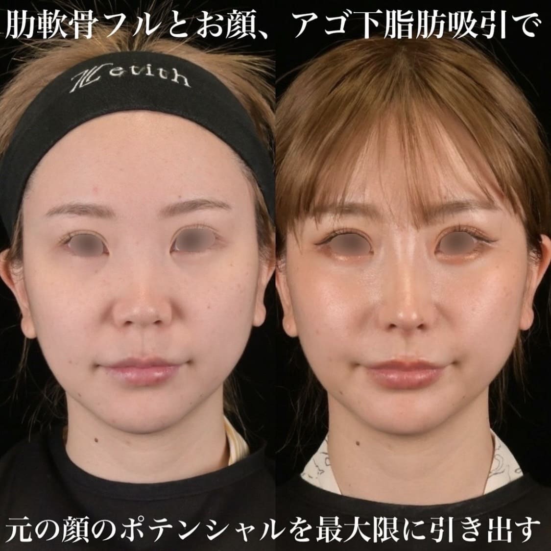 鉄医師による鼻整形の術前/術後1ヶ月