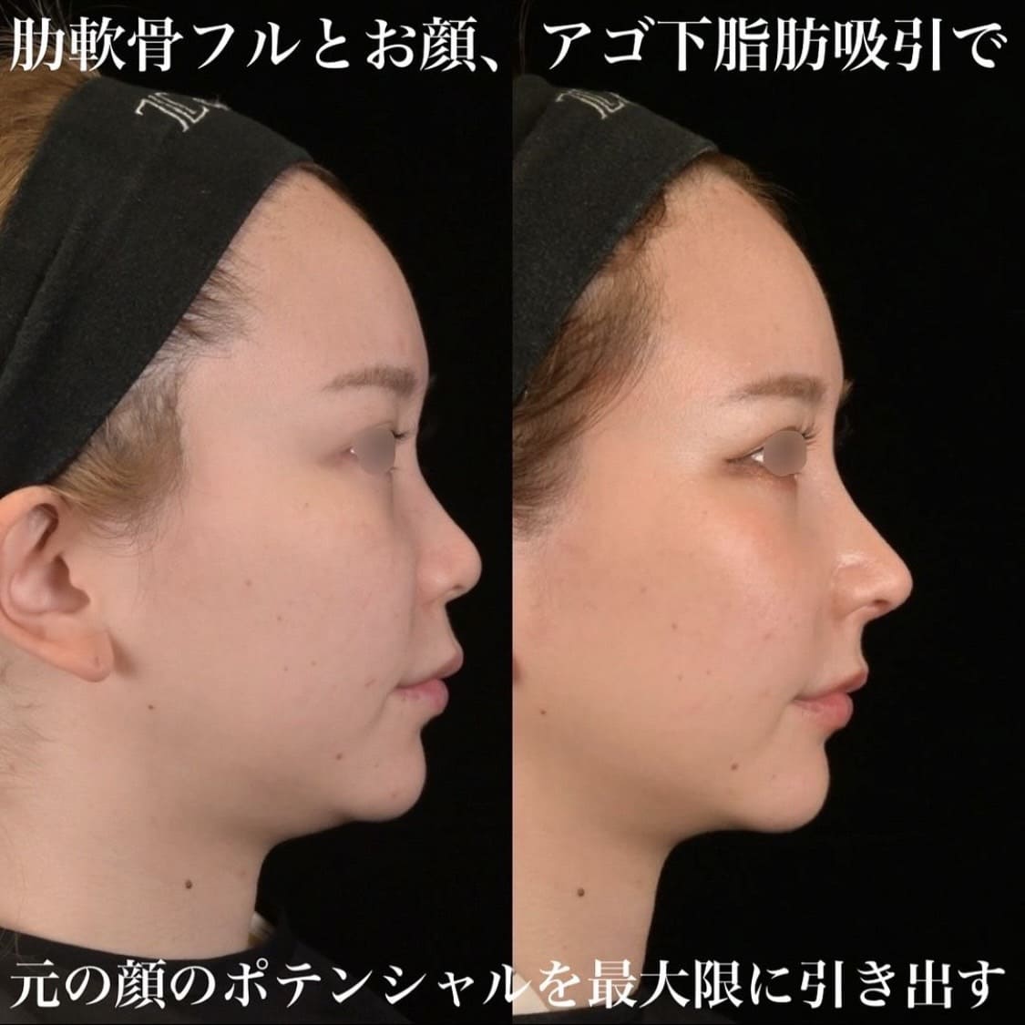 鉄医師による鼻整形の術前/術後1ヶ月 施術後 