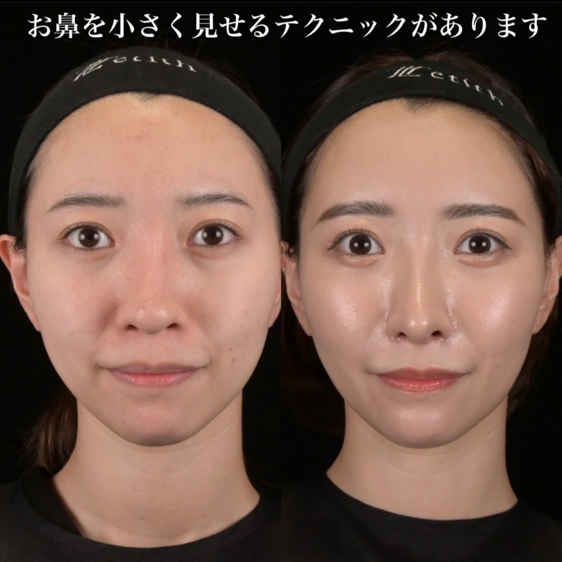鉄医師による鼻整形の術前/術後1ヶ月