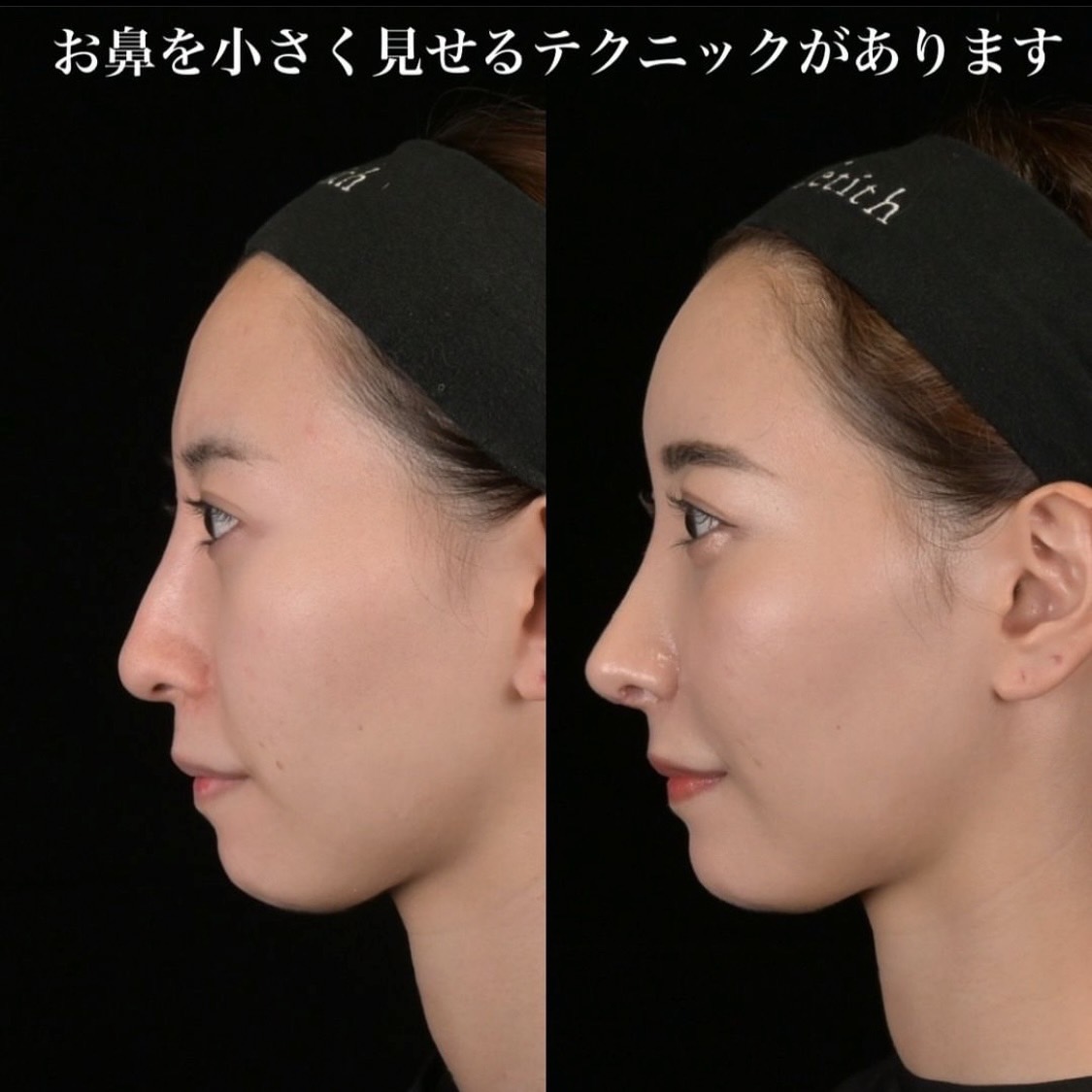 鉄医師による鼻整形の術前/術後1ヶ月 بعد 