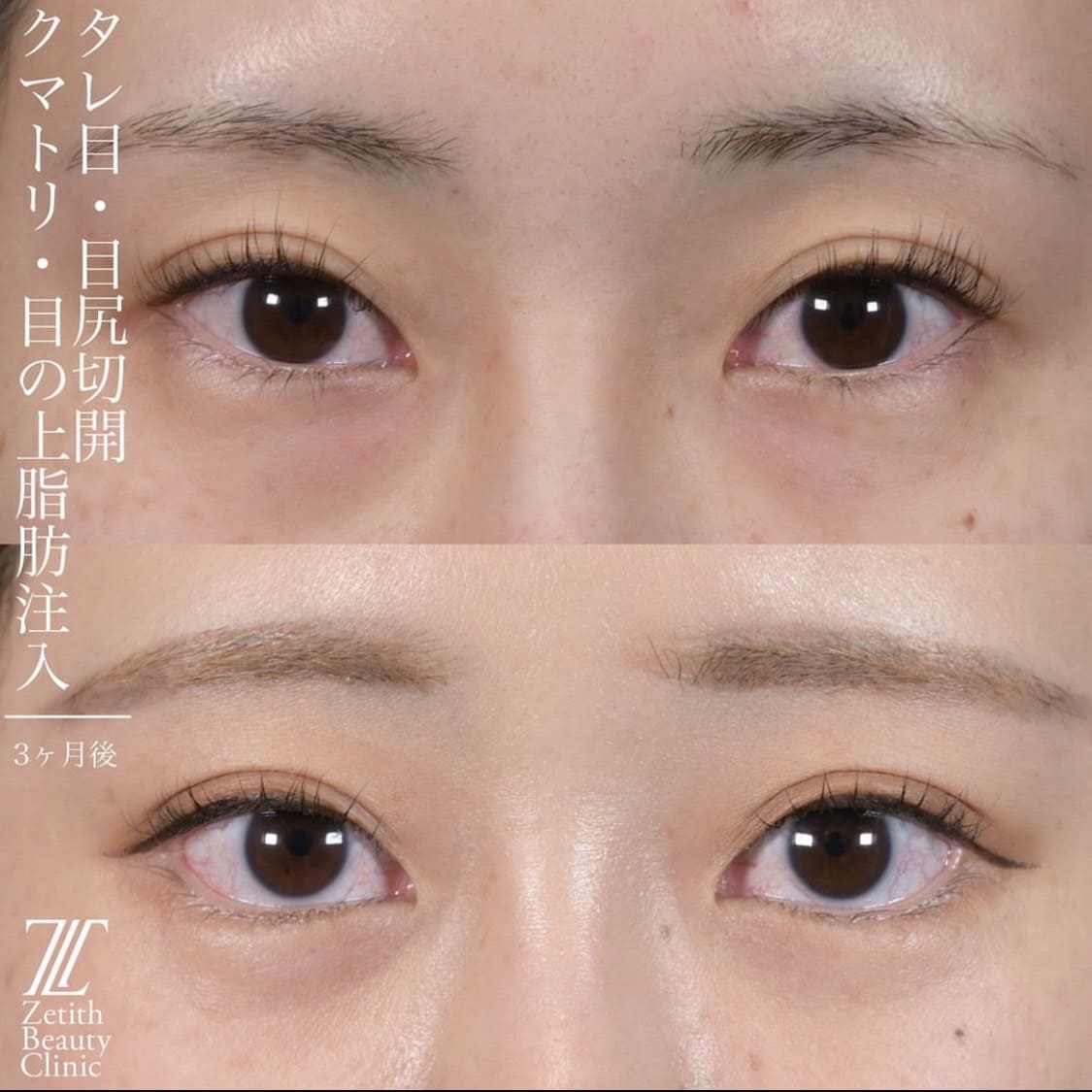 上木原医師による目元整形の術前/術後３ヶ月
