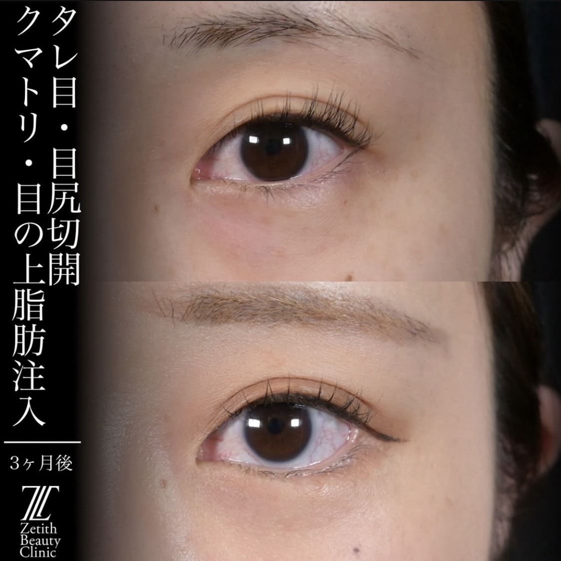 上木原医師による目元整形の術前/術後３ヶ月 术后 