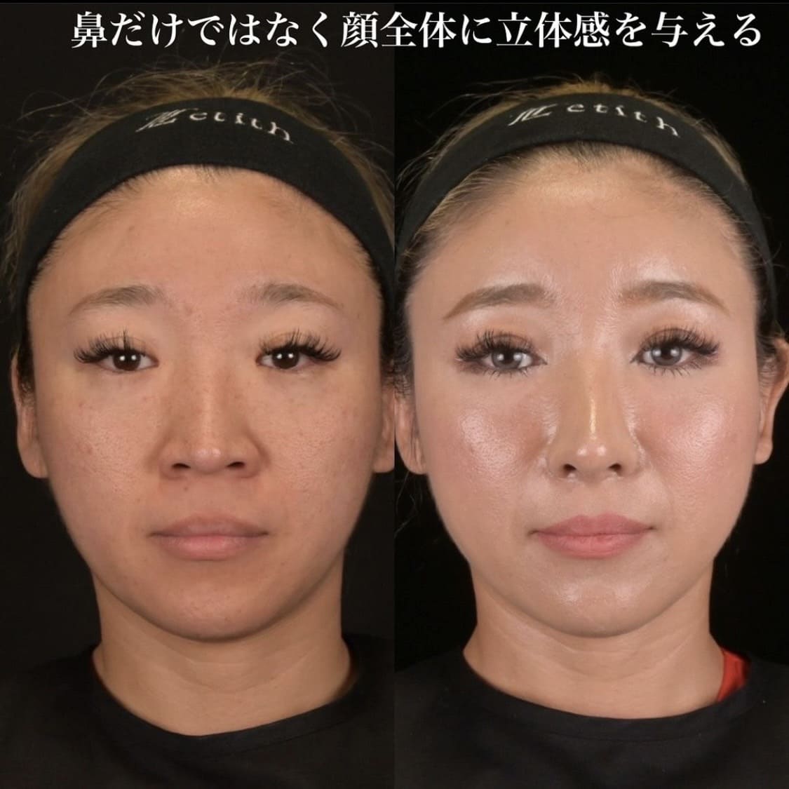鉄医師による鼻整形の術前/術後３ヶ月 หลัง 