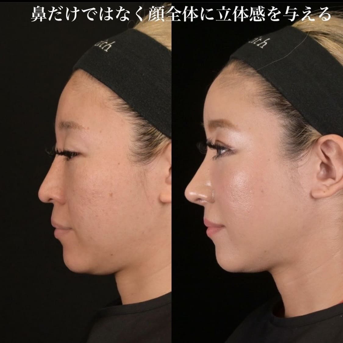 鉄医師による鼻整形の術前/術後３ヶ月