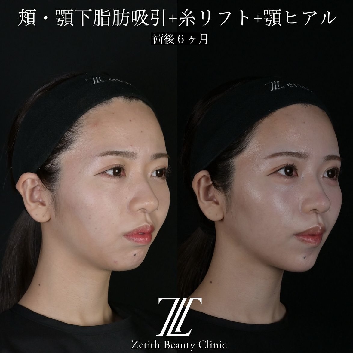 北村医師による脂肪吸引リフトの術前?術後6ヶ月