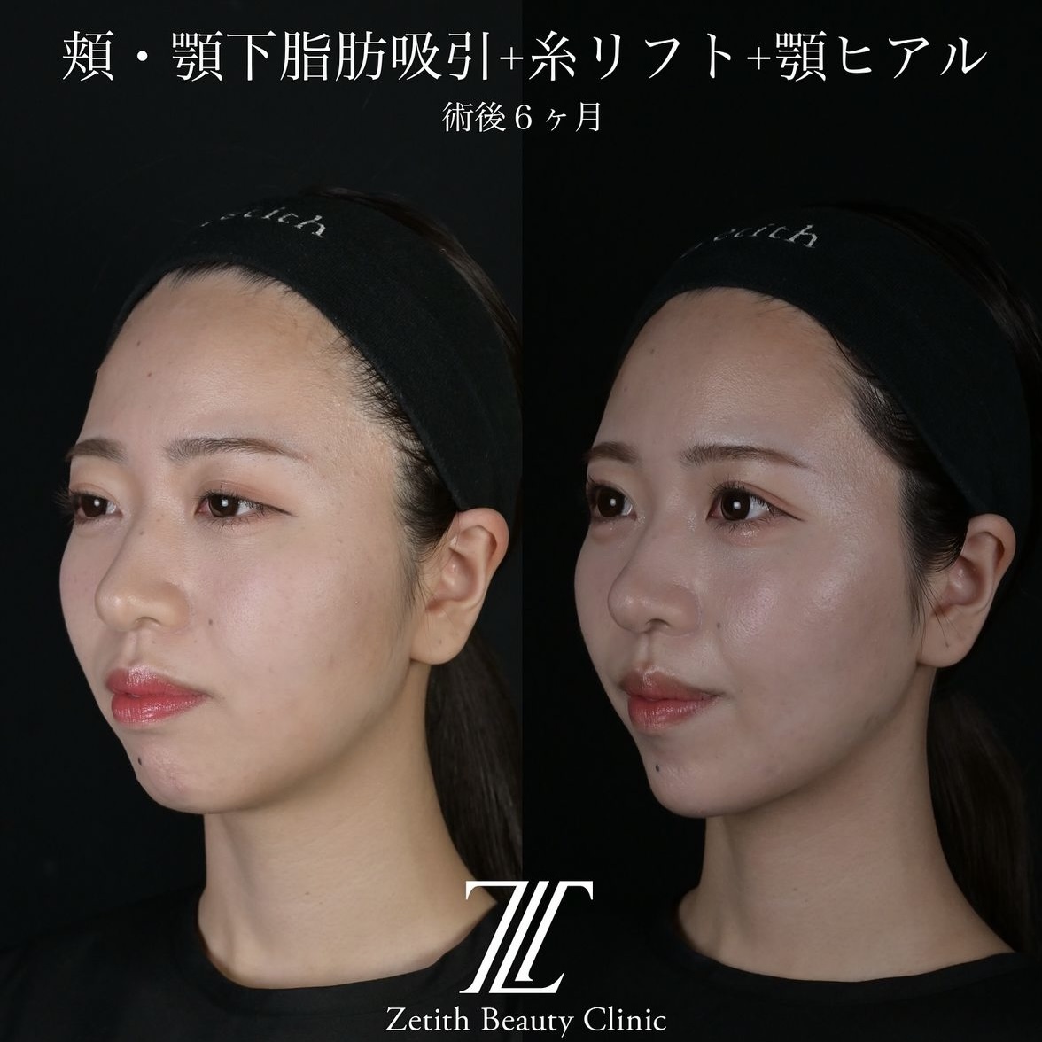 北村医師による脂肪吸引リフトの術前?術後6ヶ月 施術後 