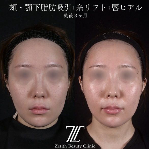 北村医師による脂肪吸引リフトの術前/術後3ヶ月