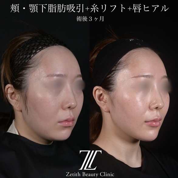 北村医師による脂肪吸引リフトの術前/術後3ヶ月 After 
