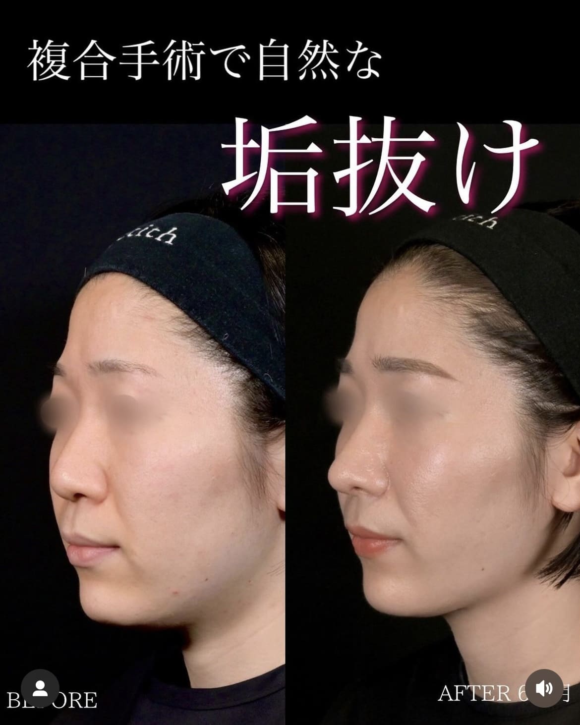 守屋医師による鼻整形の術前/術後