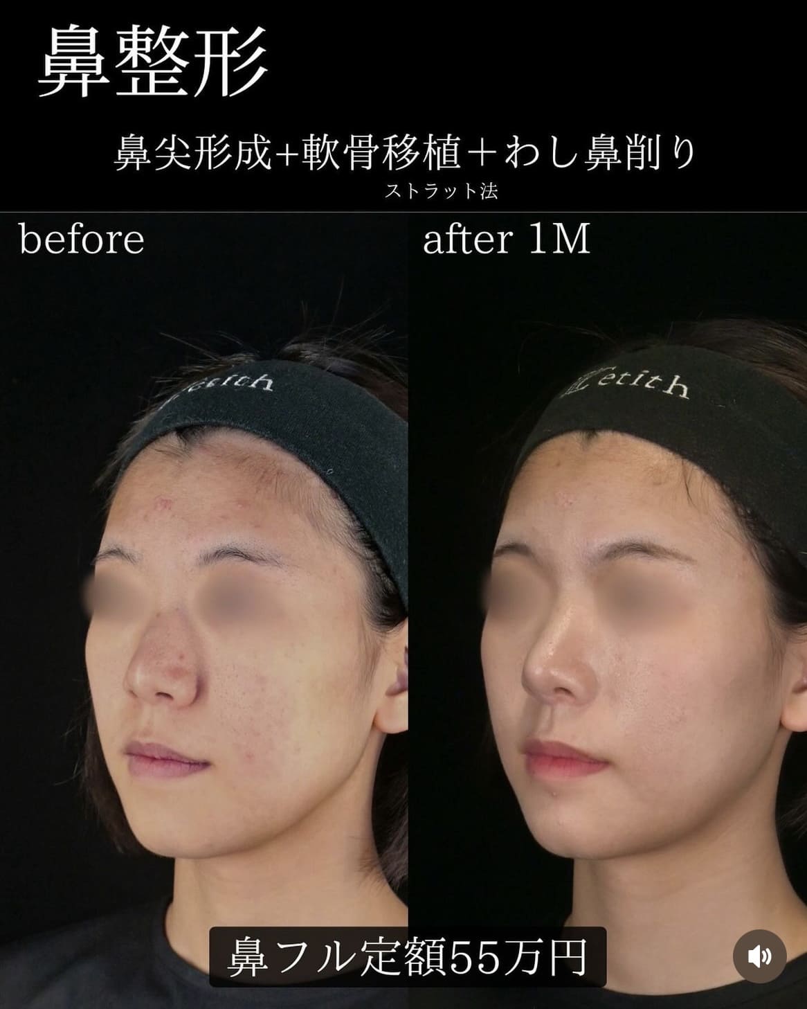 守屋医師による鼻整形の術前/術後 施術後 