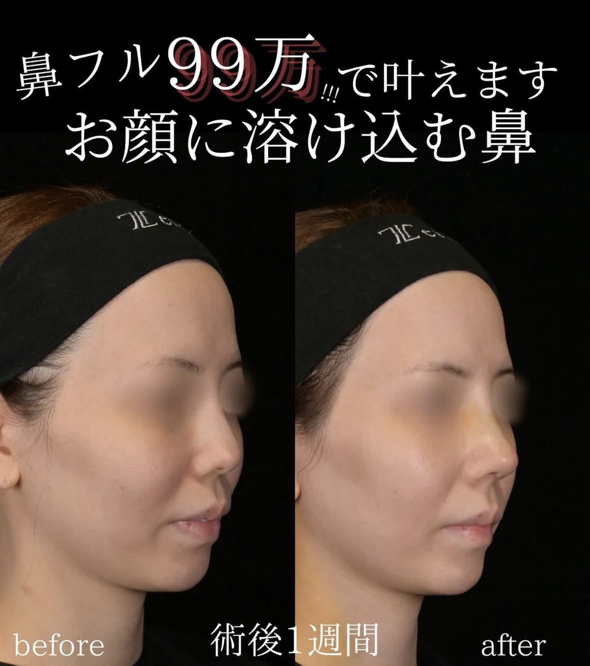 守屋医師による鼻整形の術前/術後
