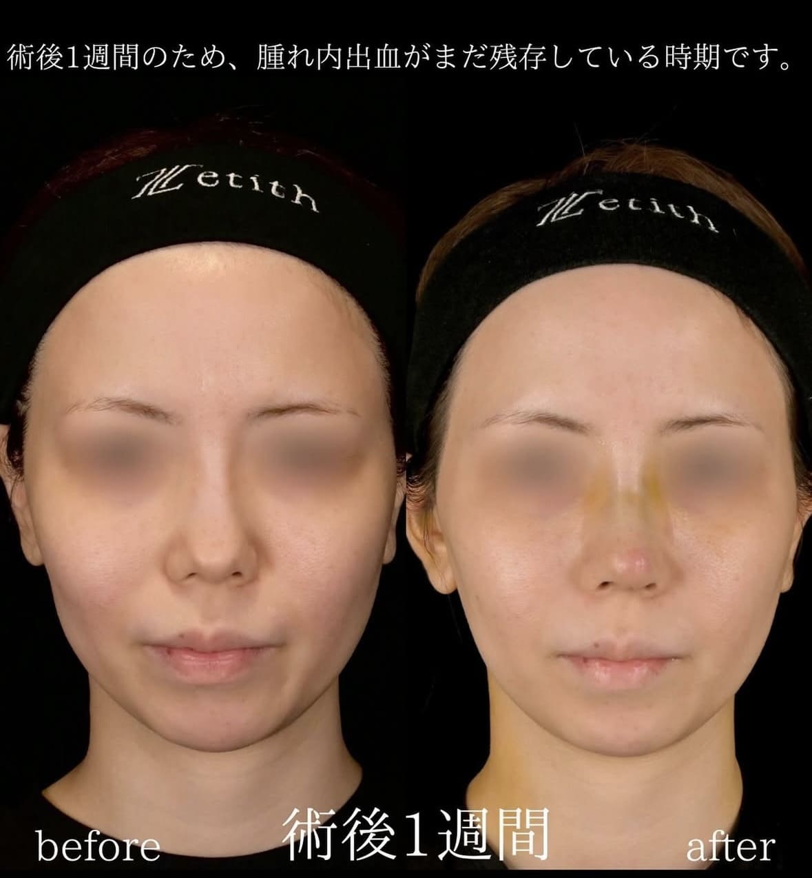 守屋医師による鼻整形の術前/術後 Дараа 