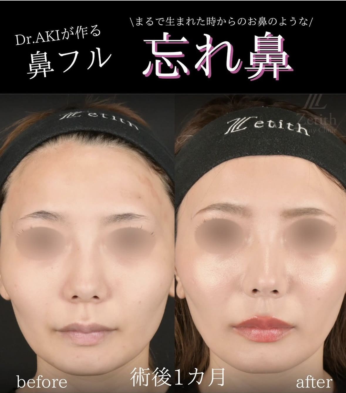 守屋医師による鼻整形の術前/術後