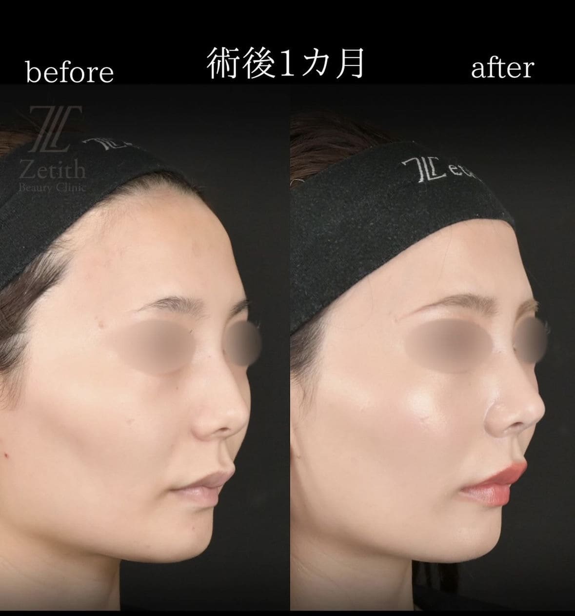守屋医師による鼻整形の術前/術後 Дараа 
