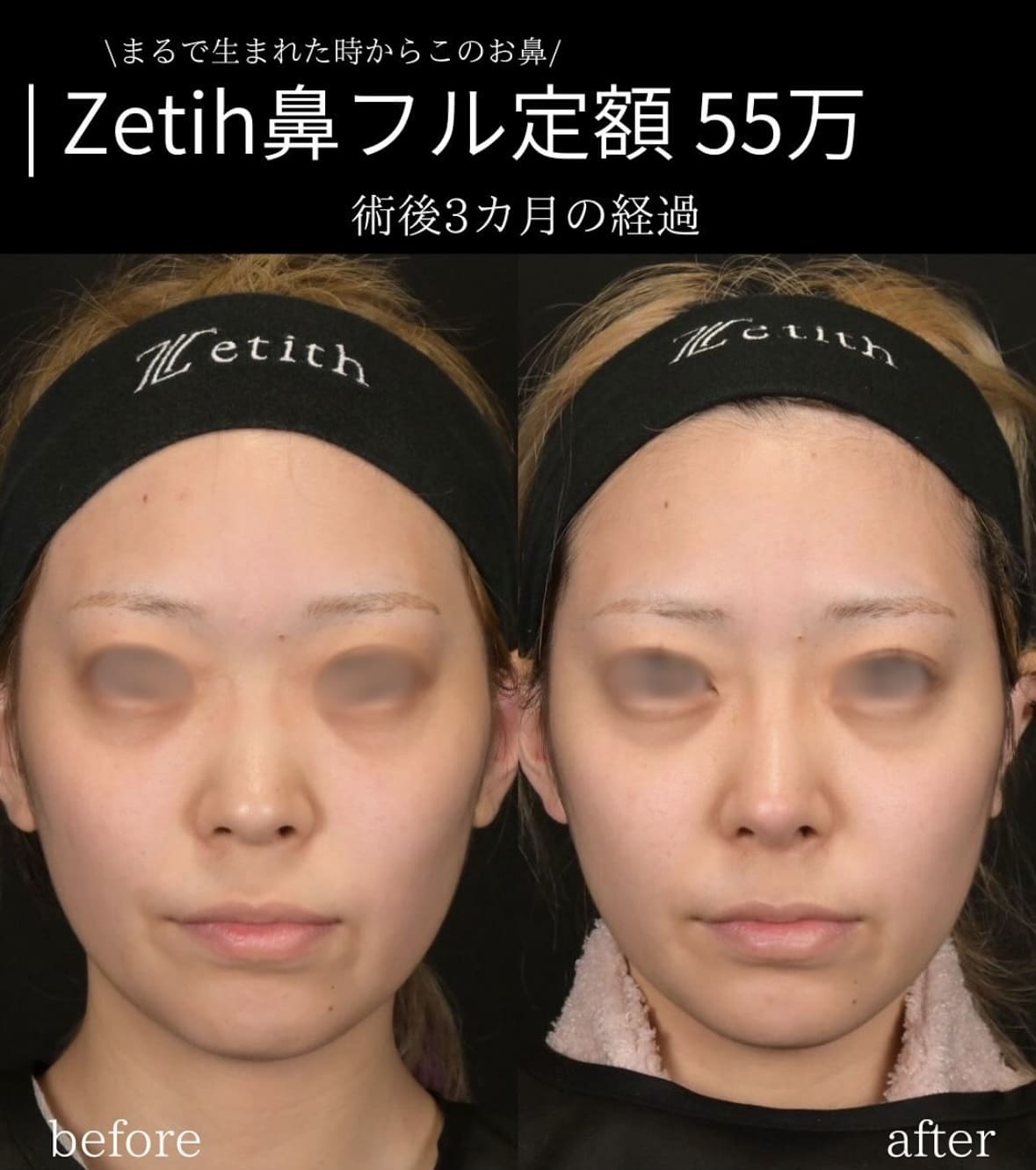 守屋医師による鼻整形の術前/術後