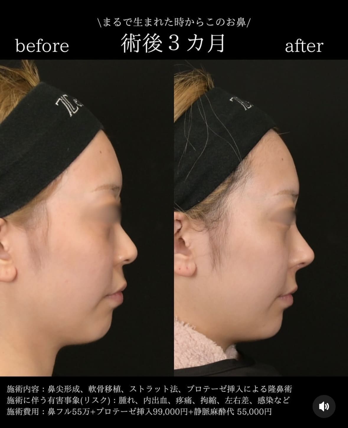守屋医師による鼻整形の術前/術後 施術後 