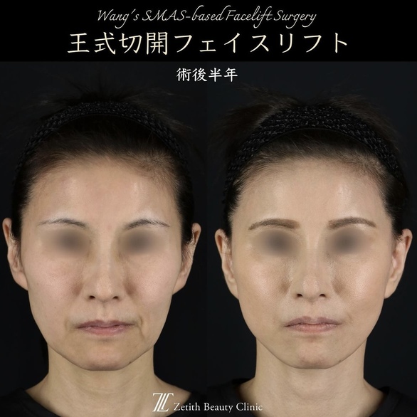 王医師による切開リフトの術前/術後