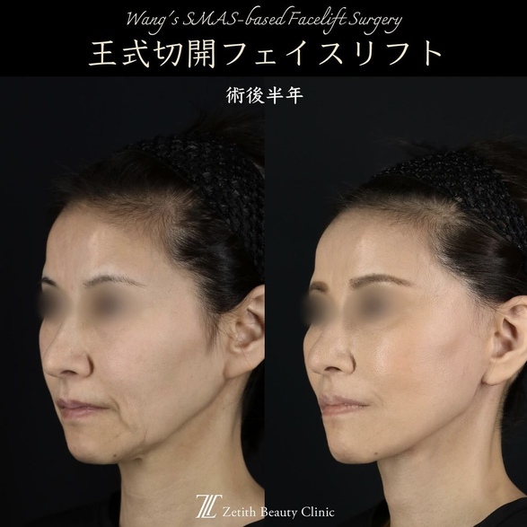 王医師による切開リフトの術前/術後 施術後 