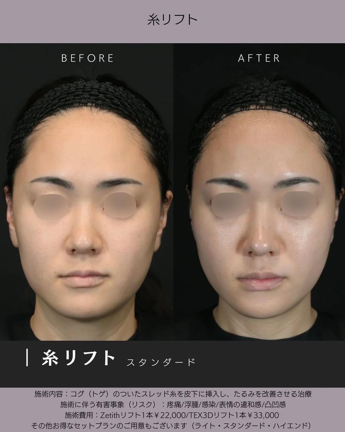 新井医師による糸リフトの術前/術後