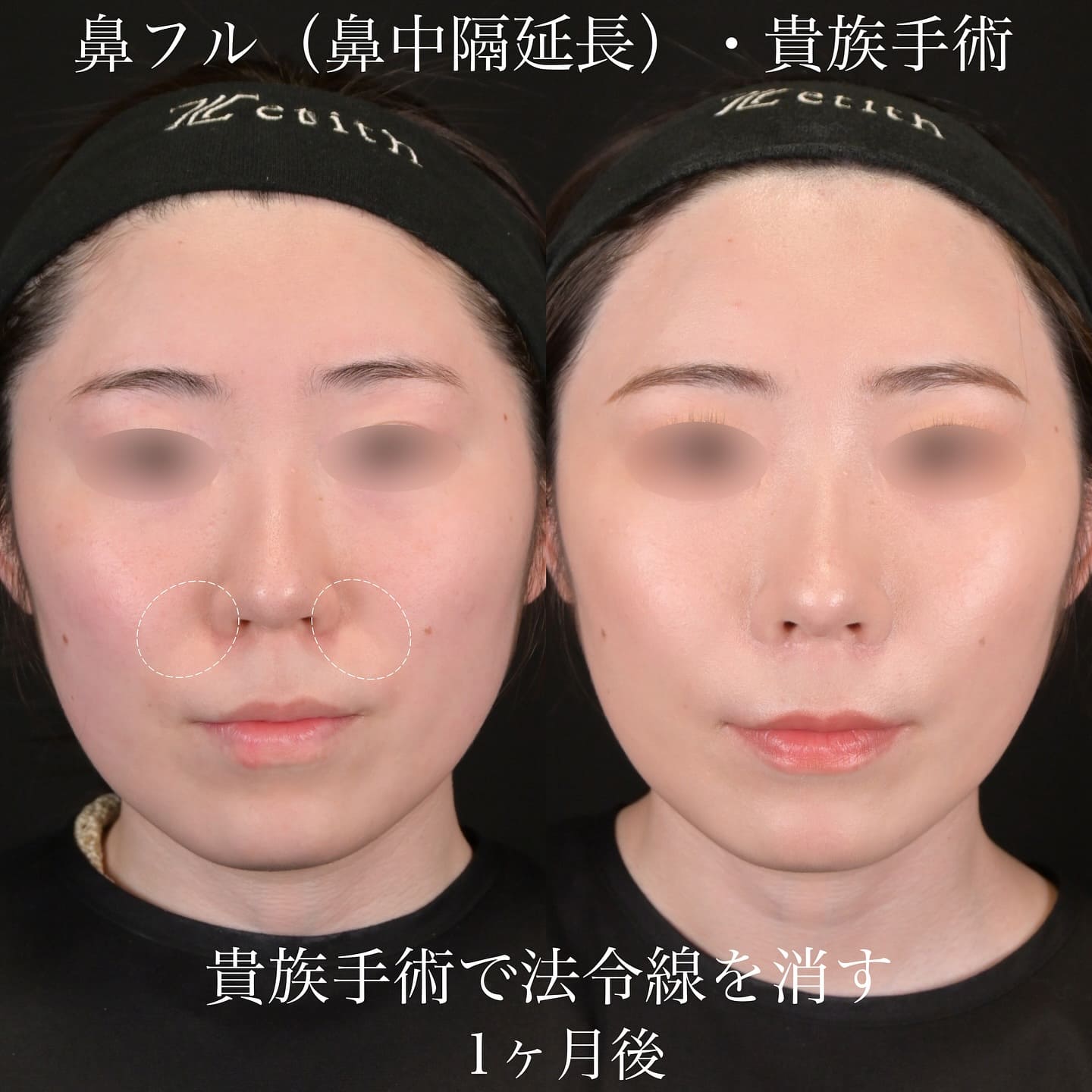 上木原医師による鼻整形の術前/術後1ヶ月 施術後 