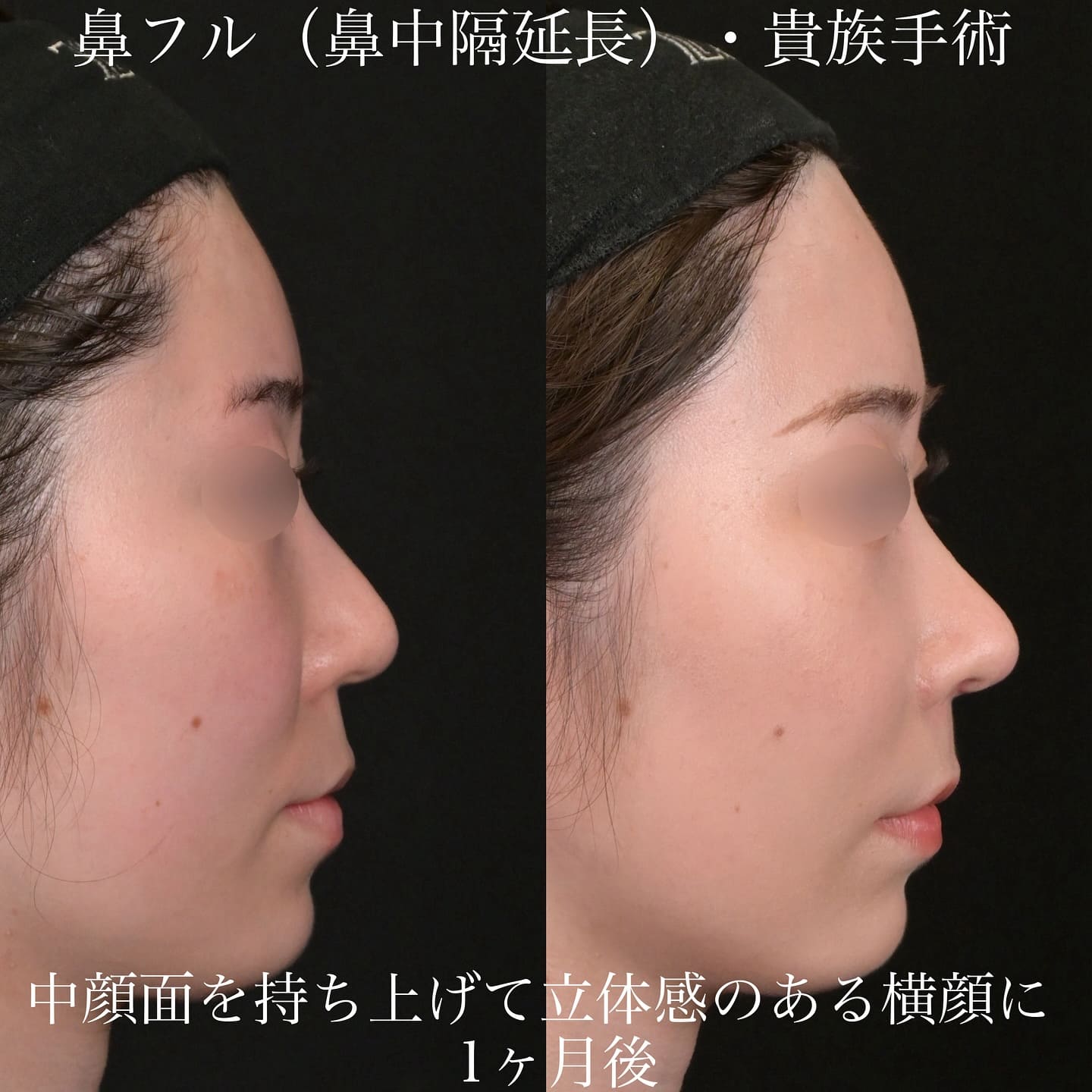 上木原医師による鼻整形の術前/術後1ヶ月