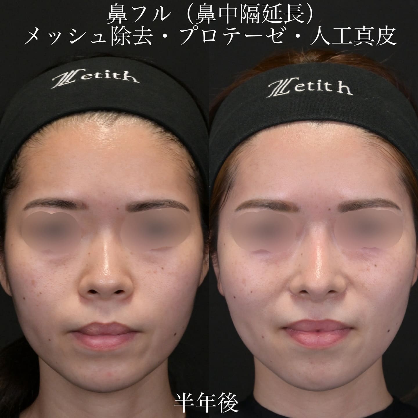 上木原医師による鼻整形の術前/術後6ヶ月