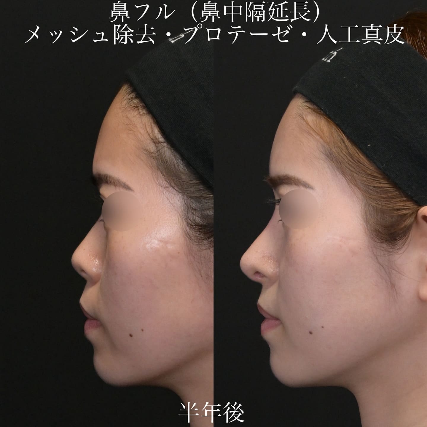 上木原医師による鼻整形の術前/術後6ヶ月 施術後 