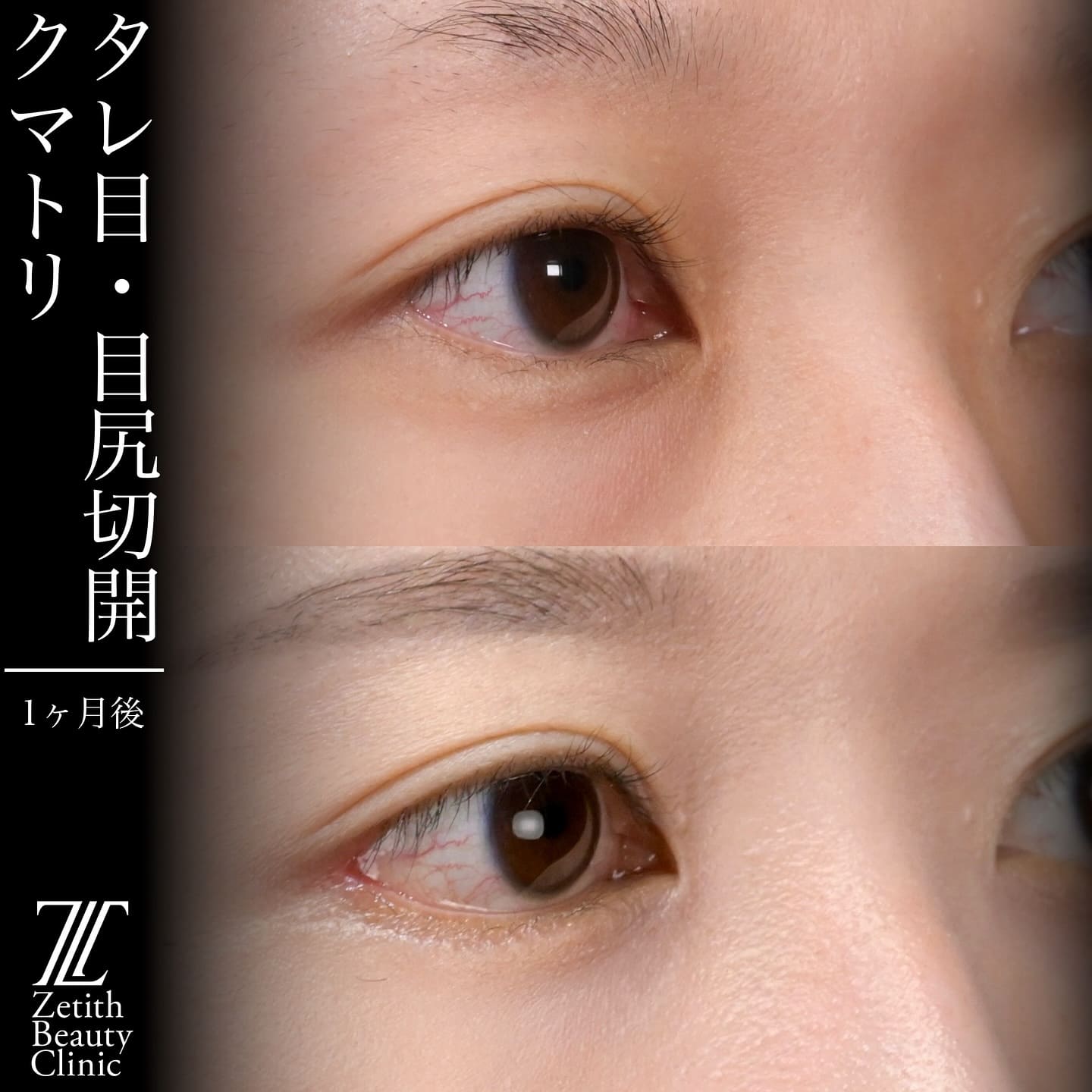 上木原医師による目元整形の術前/術後1ヶ月 بعد 