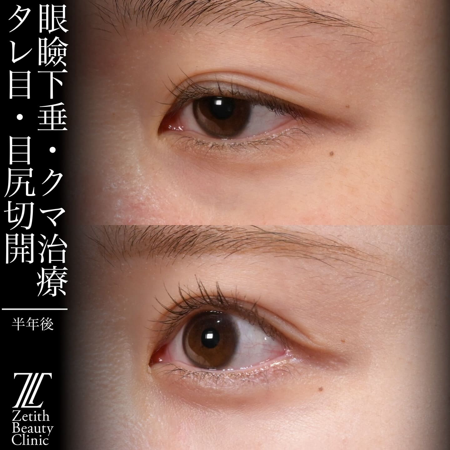 上木原医師による目元整形の術前/術後1ヶ月 بعد 