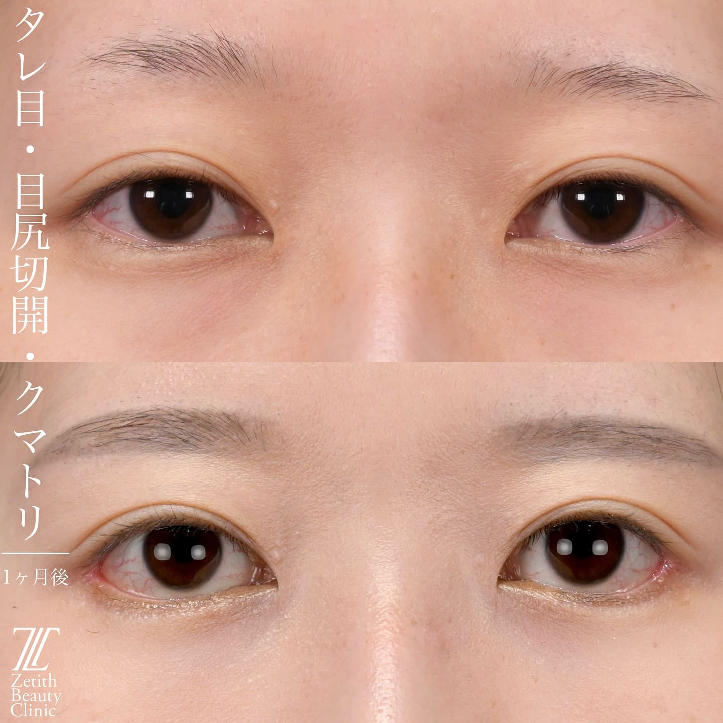 上木原医師による目元整形の術前/術後1ヶ月
