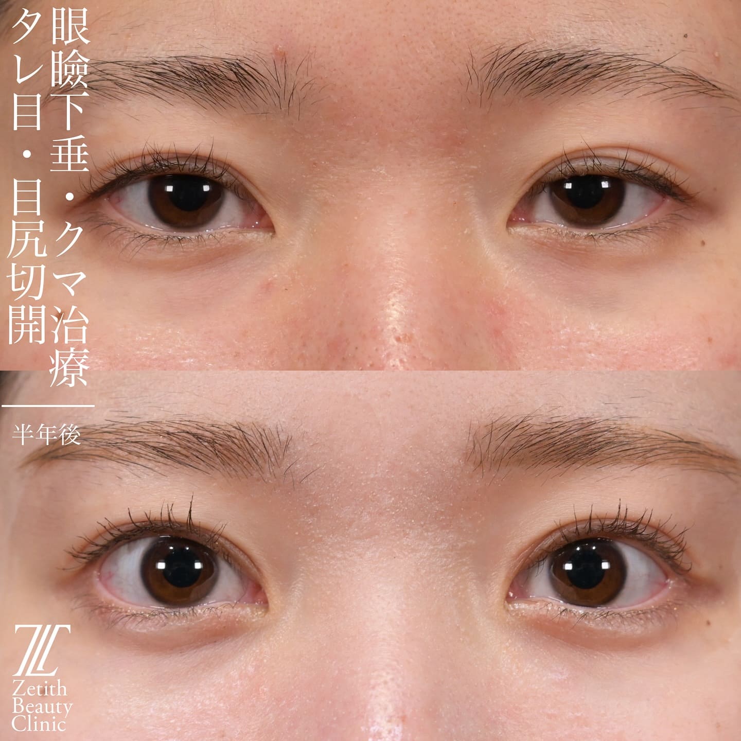 上木原医師による目元整形の術前/術後1ヶ月