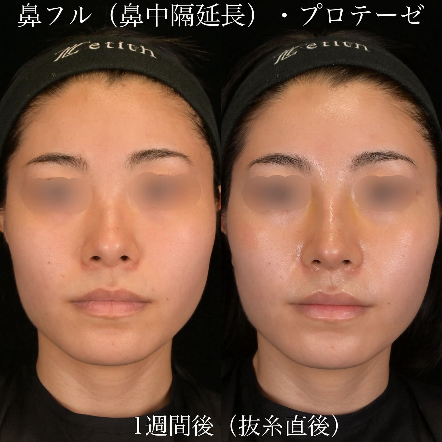 上木原医師による鼻整形の術前/術後1週間 术后 